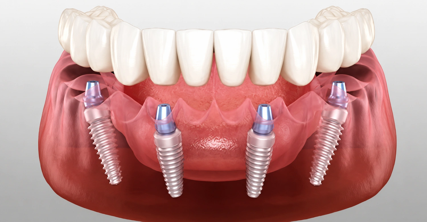 4 Implant Bridge A Fixed, Long Lasting Solution for Missing Teeth